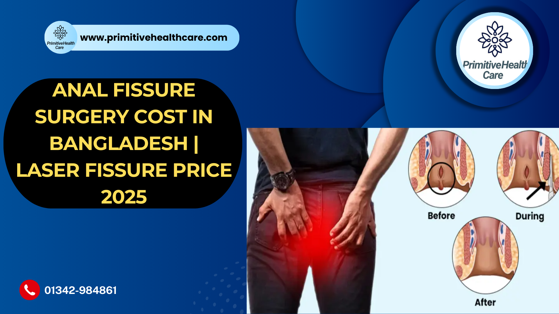 Anal Fissure Surgery Cost in Bangladesh | Laser Fissure Price 2025